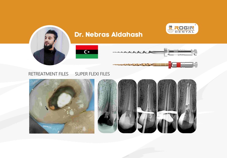 Non-Surgical Retreatment Case